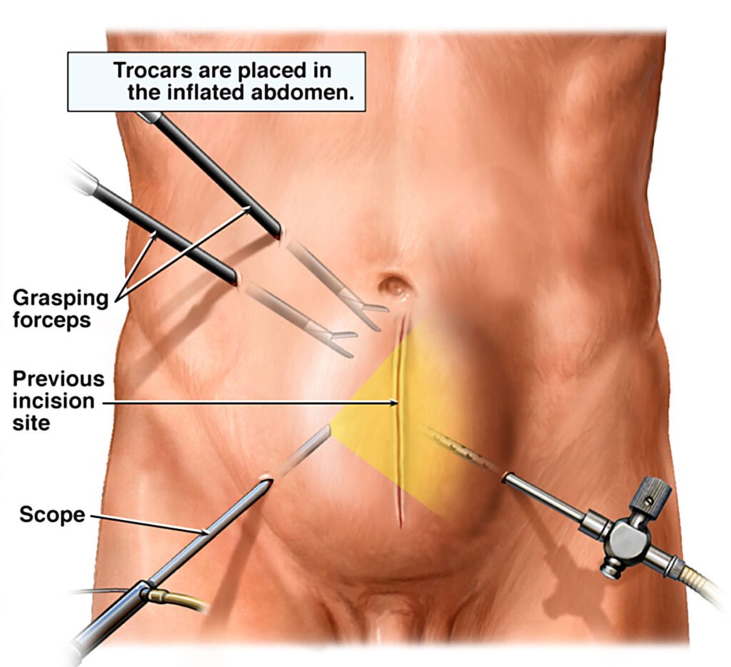 Hernia Surgery in Bangalore