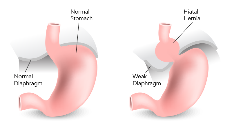 Hiatal Hernia Surgery in Bangalore