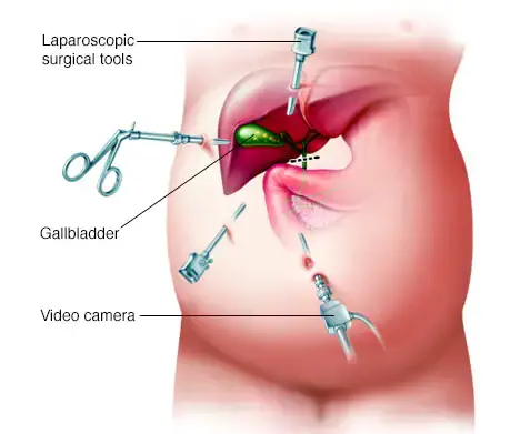 Laparoscopic surgery in Bangalore
