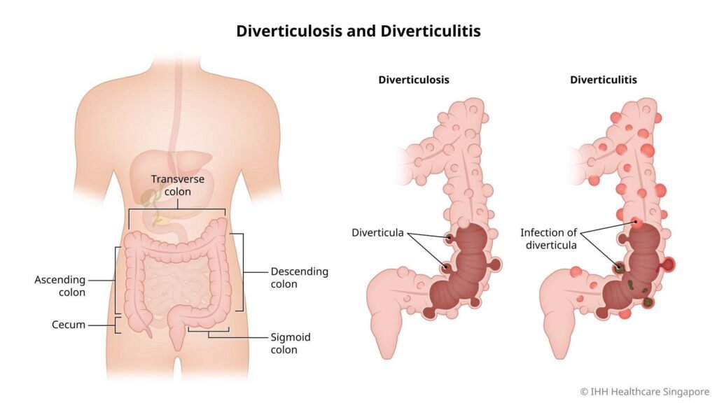 Diverticulitis Treatment in Bangalore