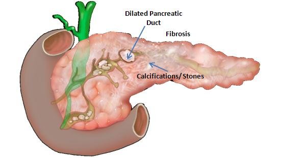 Chronic Pancreatitis Treatment in Bangalore