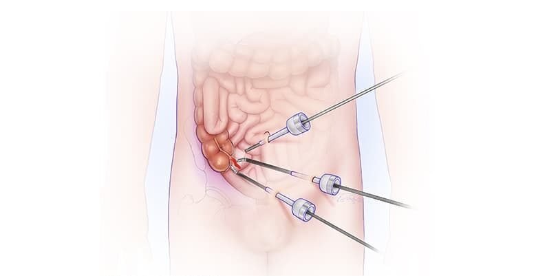 Laparoscopic Appendectomy in Bangalore