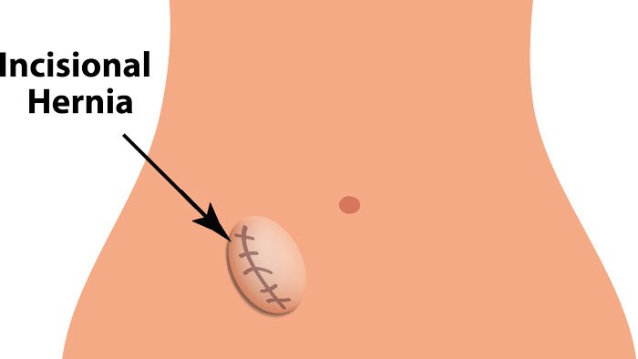 Incisional hernia surgery in Bangalore