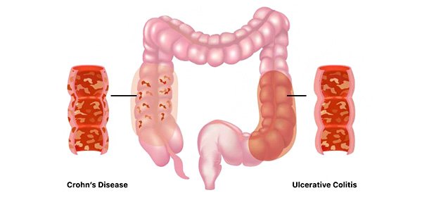 Ulcerative Colitis Treatment in Bangalore