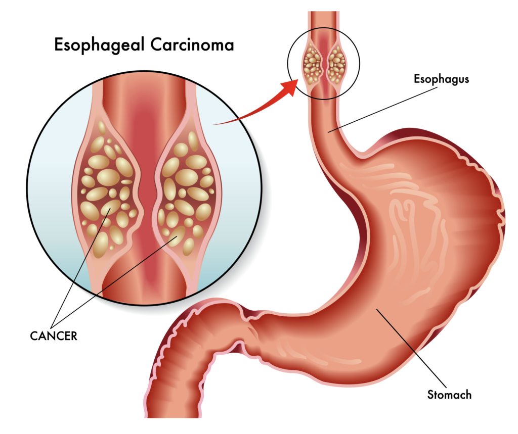 Esophageal Treatment in Bangalore